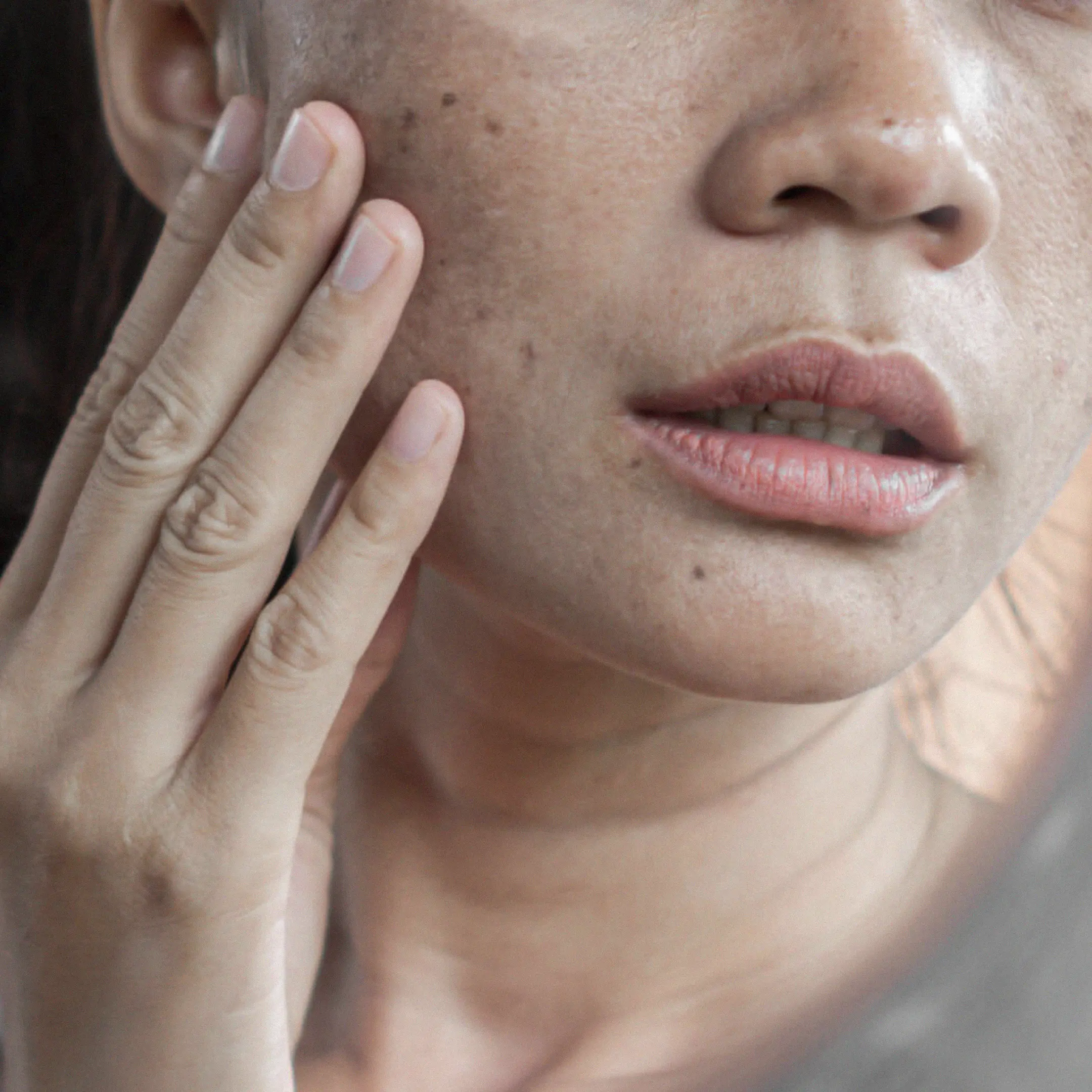 Manchas, Melasma e Melanoses